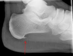 heel spur formed by plantar fascitis